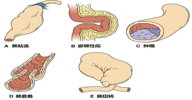 腸梗塞